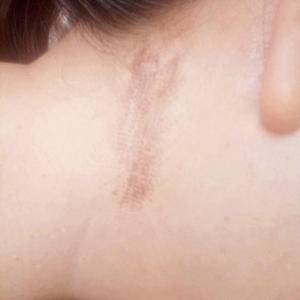 赣州寻乌县好的疤痕医院