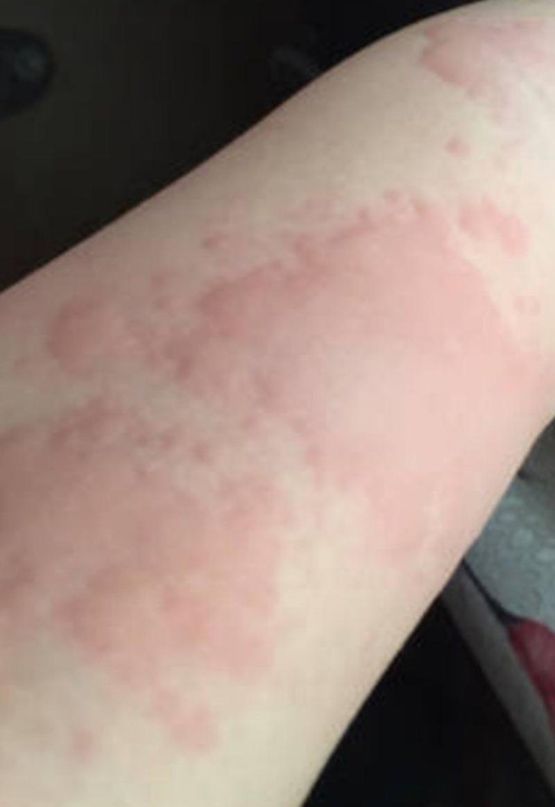 患上了慢性荨麻疹怎么办