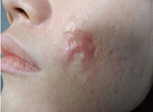 瑞金市正规去疤痕的医院有哪些