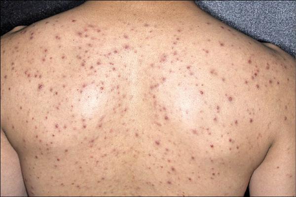 患上了毛囊炎该如何进行治疗