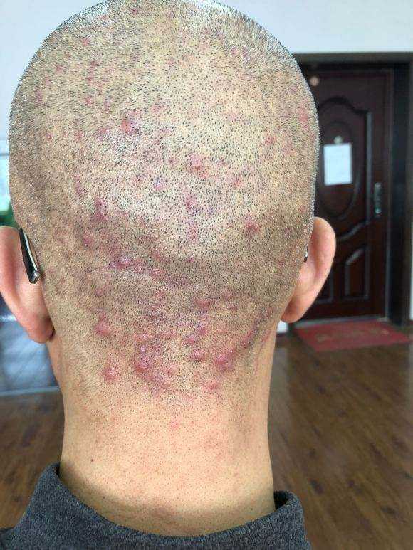 毛囊炎是怎么引起的