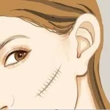 关于疤痕,你需要知道这些